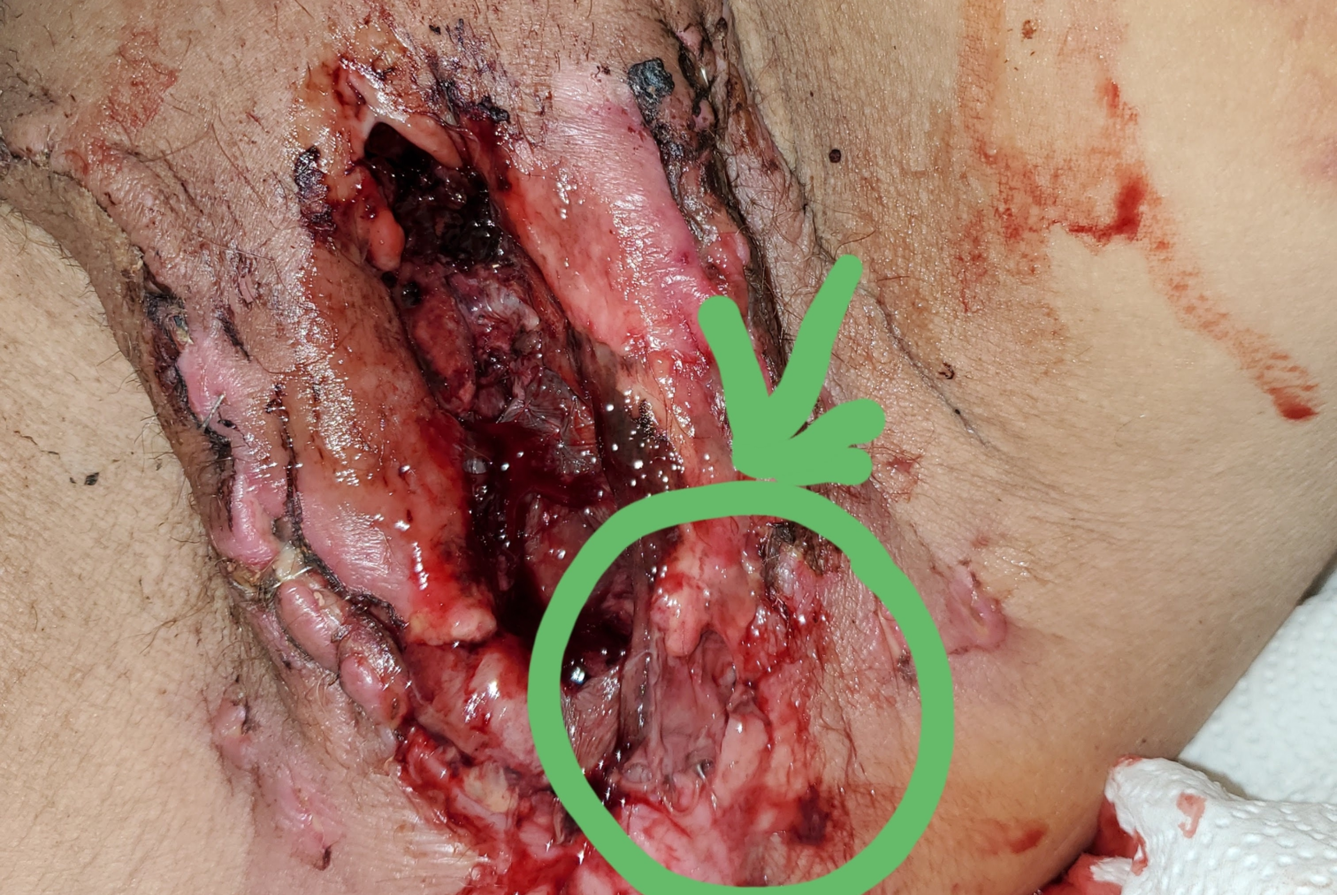 axe wound.jpeg