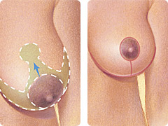breast-reduction2.jpeg