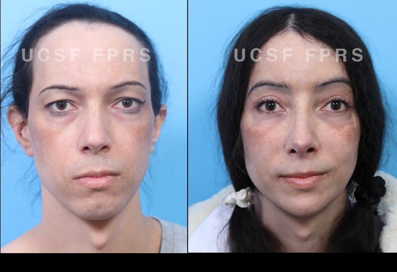 ffs-case7ab.jpg