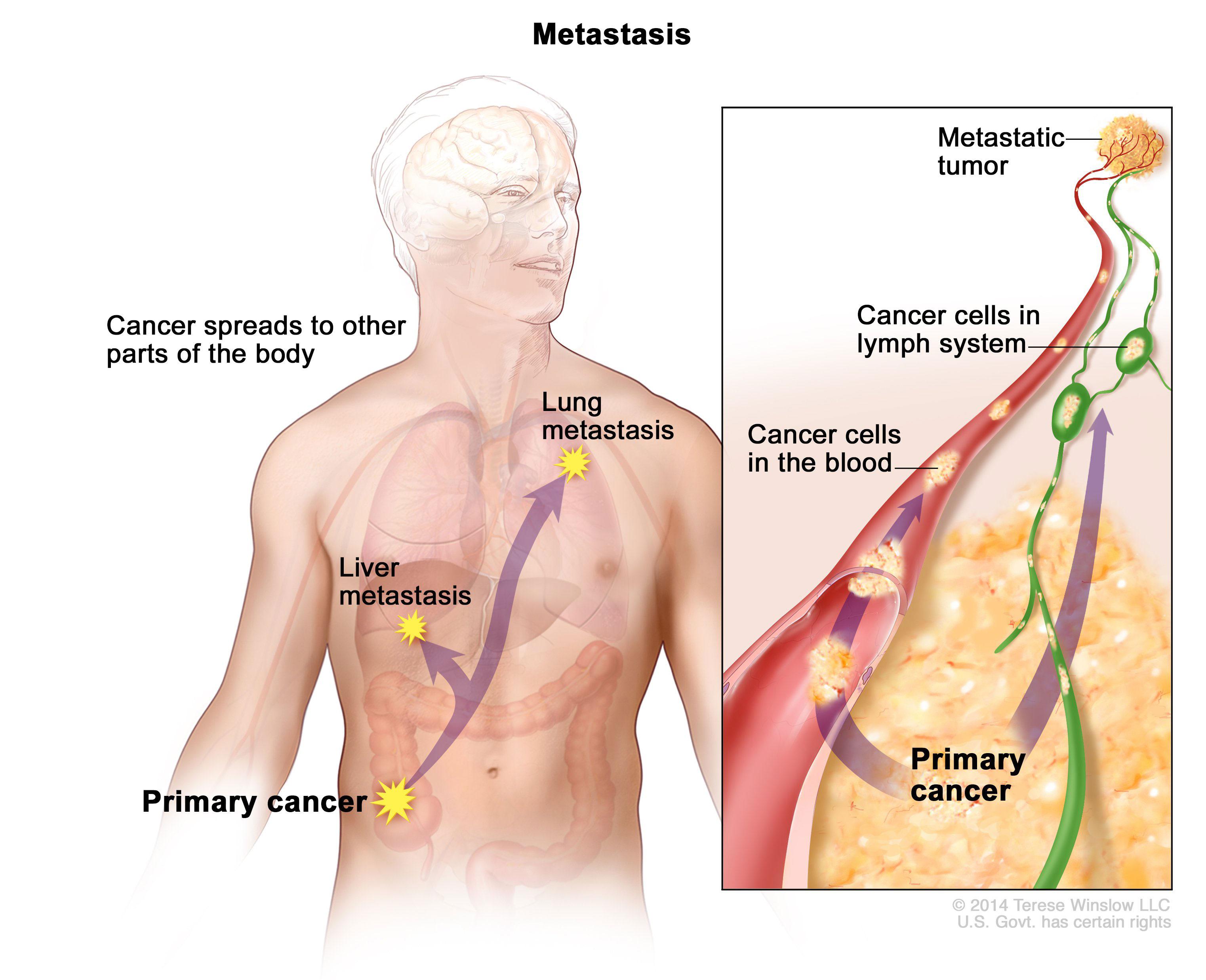 metastasis-enlarge.jpg