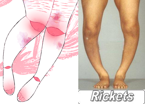 rickets.png