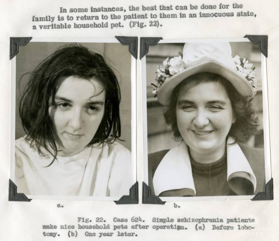 schizophrenia-before-after.jpeg