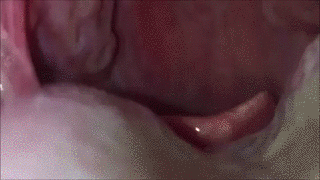 tonsil stones.gif