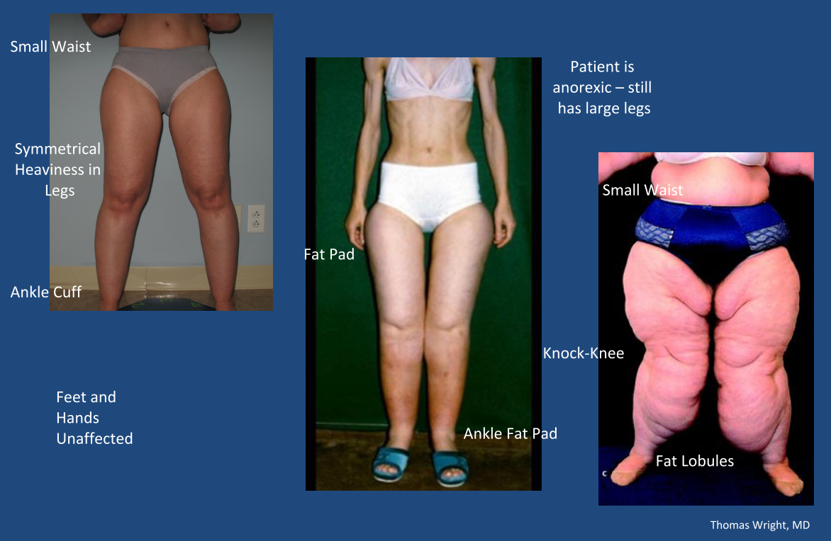 whatislipedema.png